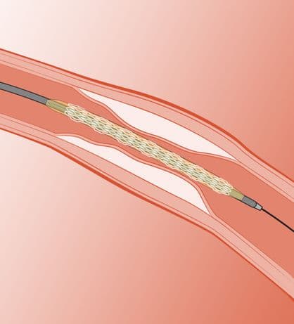 Crimped BRS at lesion